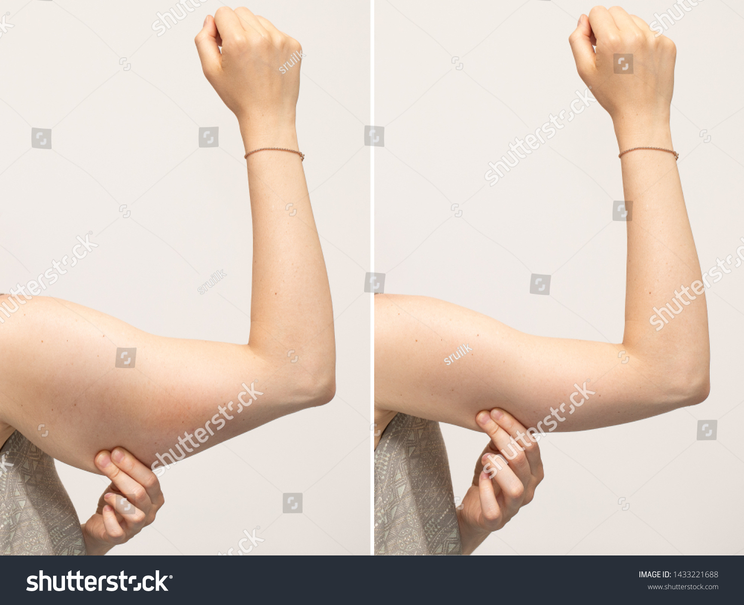 A split screen of a woman pinching the skin beneath her arm. Showing the before and after results of brachioplasty surgery, also called an arm lift. #1433221688