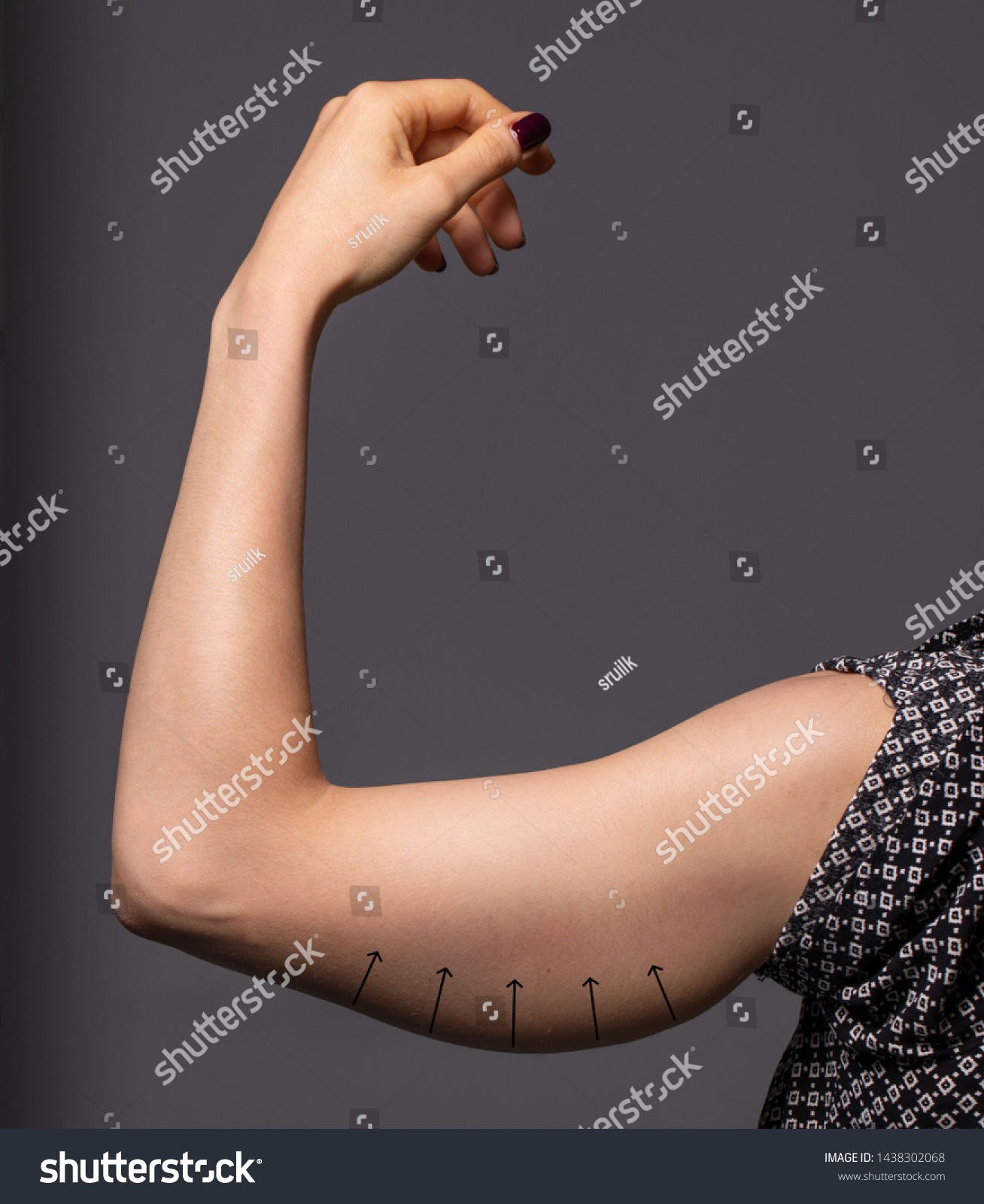 A young woman’s arm is seen up close before a brachioplasty procedure. Arrows point up to show the direction the lady wishes the loose skin to go after successful surgery. #1438302068