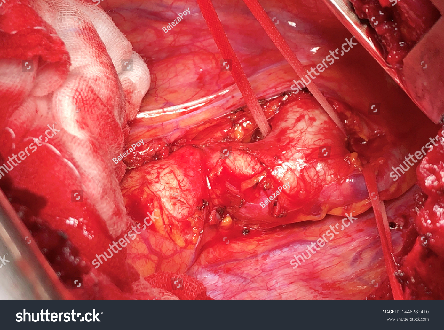 Coarctation of the aorta in adult (CoA or CoAo), also called aortic narrowing, is a congenital heart disease #1446282410