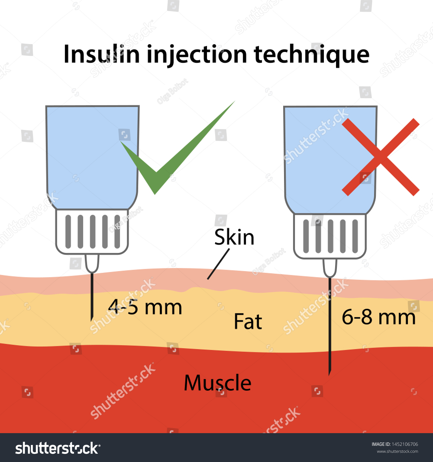 Insulin injection technique for diabetes. Royalty Free Stock Vector