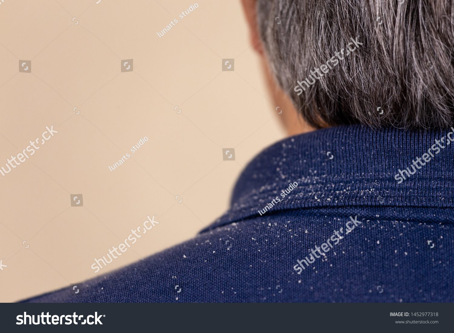 Close-up view of a man who has a lot of dandruff from his hair on his shirt and shoulders. Fatty Dandruff #1452977318