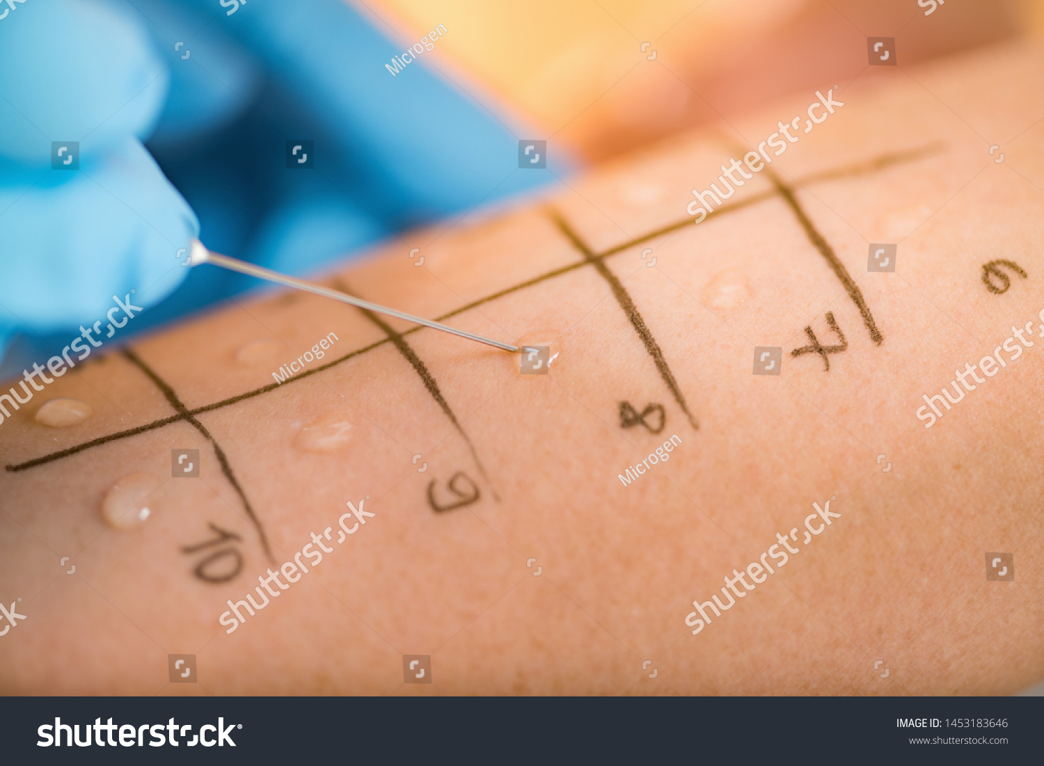 Immunologist Doing Skin Prick Allergy Test on a Woman’s Arm #1453183646