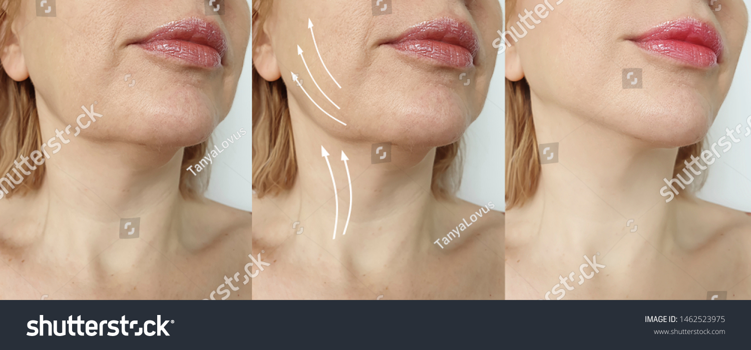 woman double chin before and after treatment #1462523975