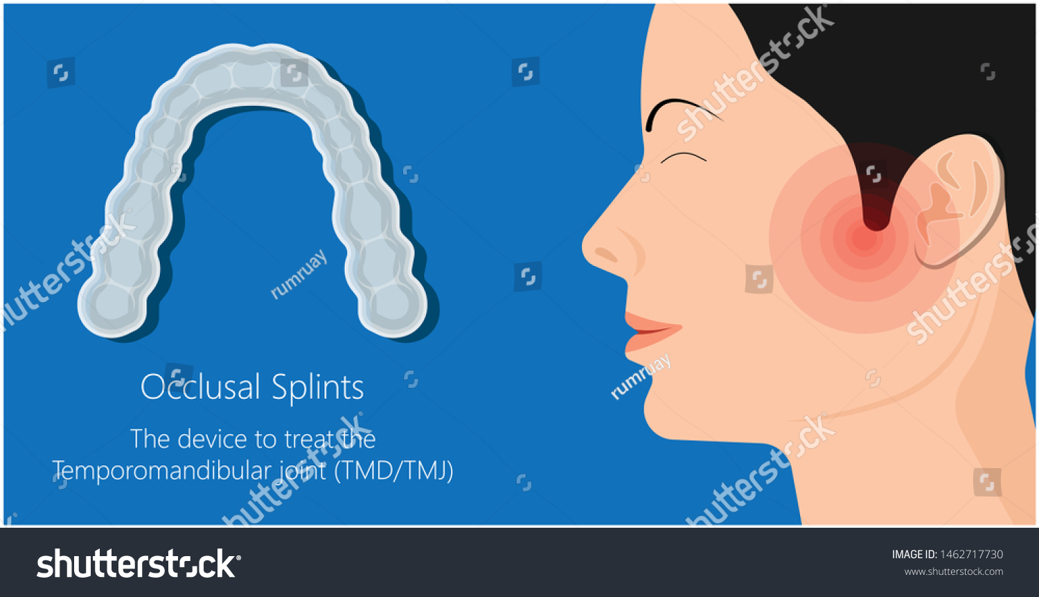 Temporomandibular Joint Disorders TMD TMJ Treat - Royalty Free Stock ...