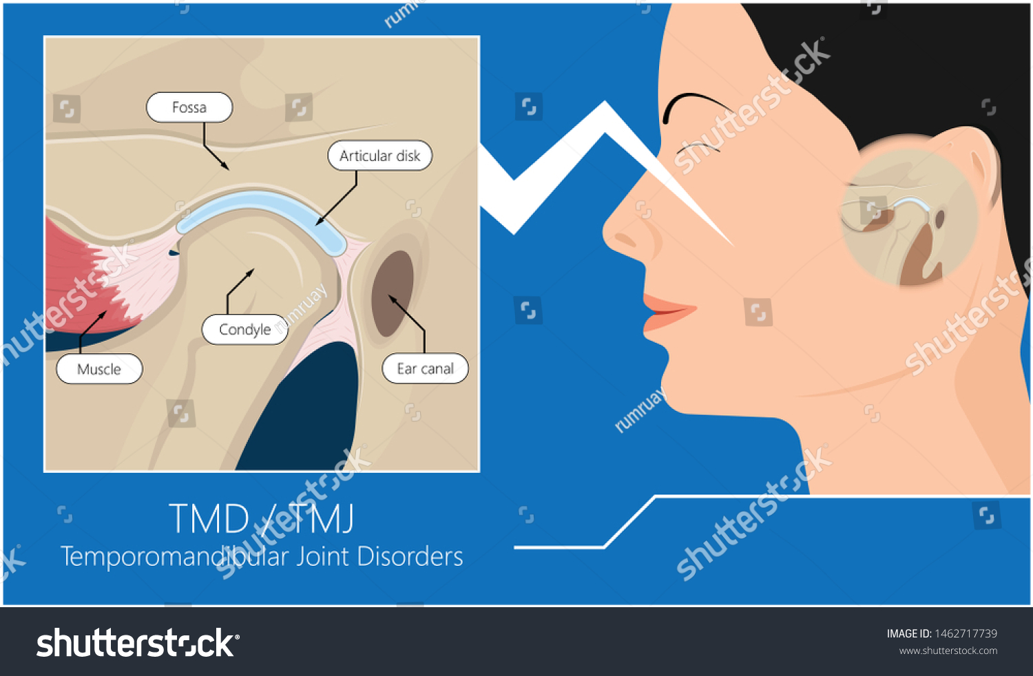 Temporomandibular Joint Disorders TMD TMJ Treat - Royalty Free Stock ...