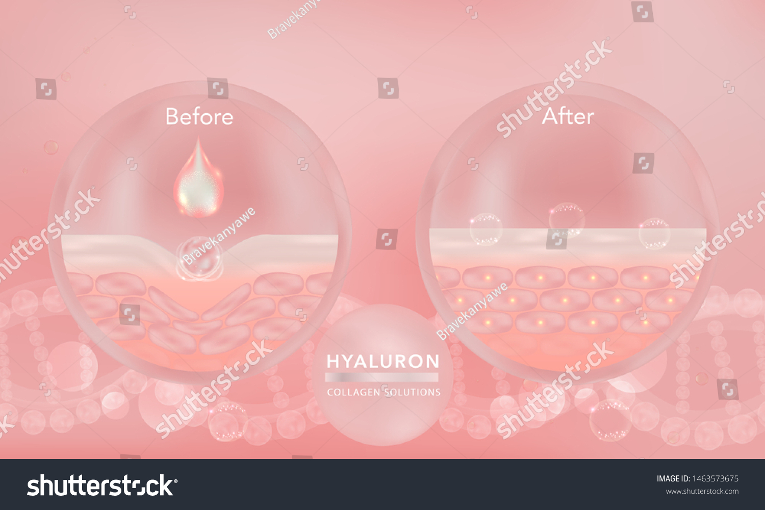 Hyaluronic Acid Before And After Skin Solutions - Royalty Free Stock ...