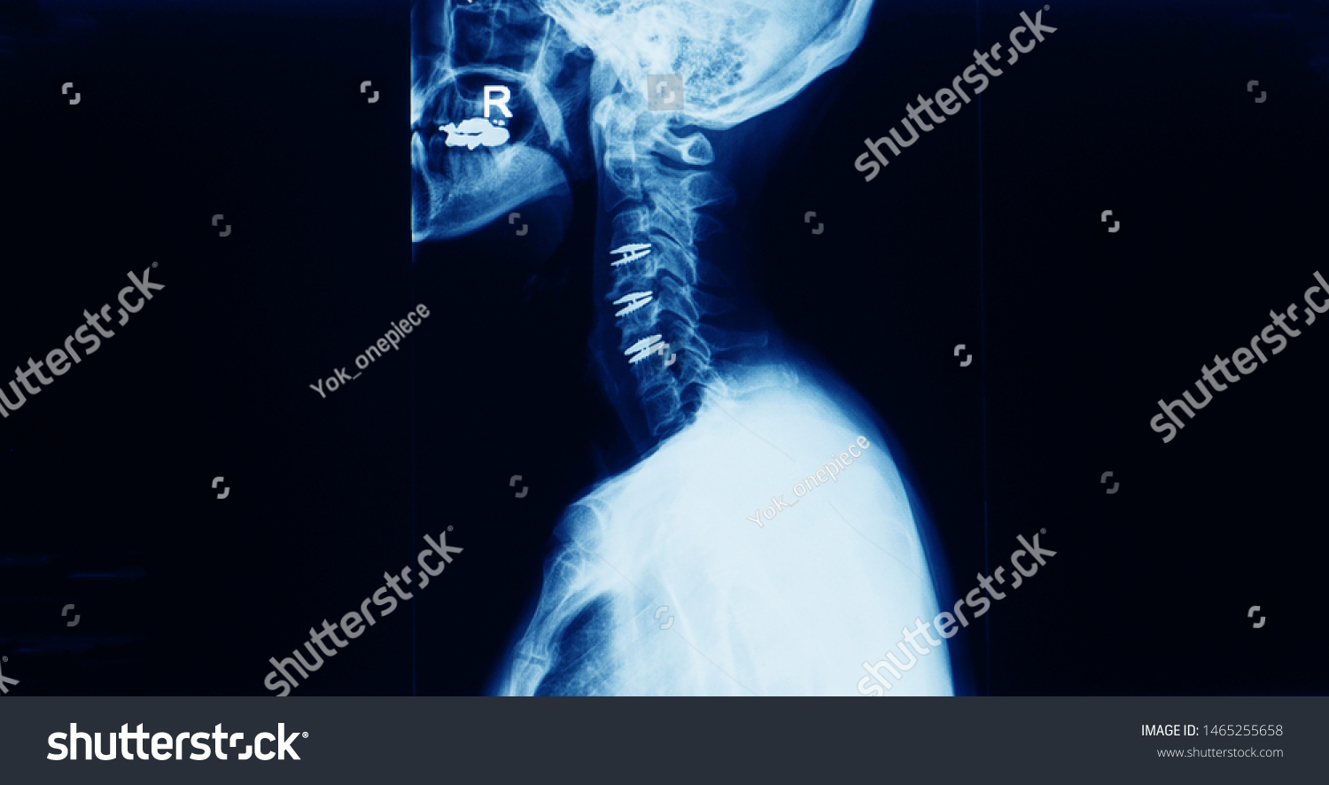lateral projection x-ray of cervical spine showing multiple level total disc replacement operation in a patient with cervical spondylotic myelopathy. The patient has neck pain and spinal stenosis. #1465255658
