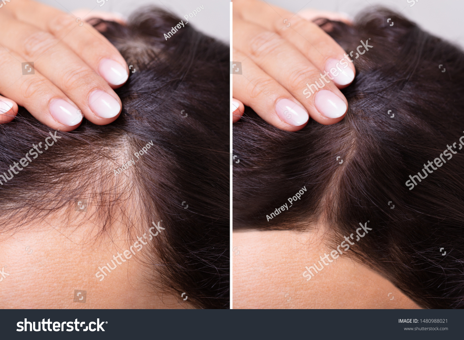 Woman Before And After Hair Loss Treatment #1480988021