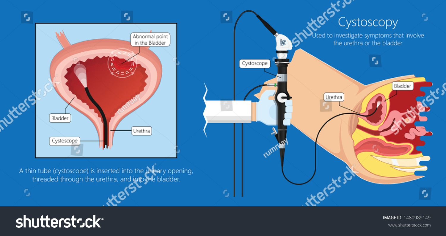 Cystoscopy Diagnose Bladder Diseases And Royalty Free Stock Vector 1480989149