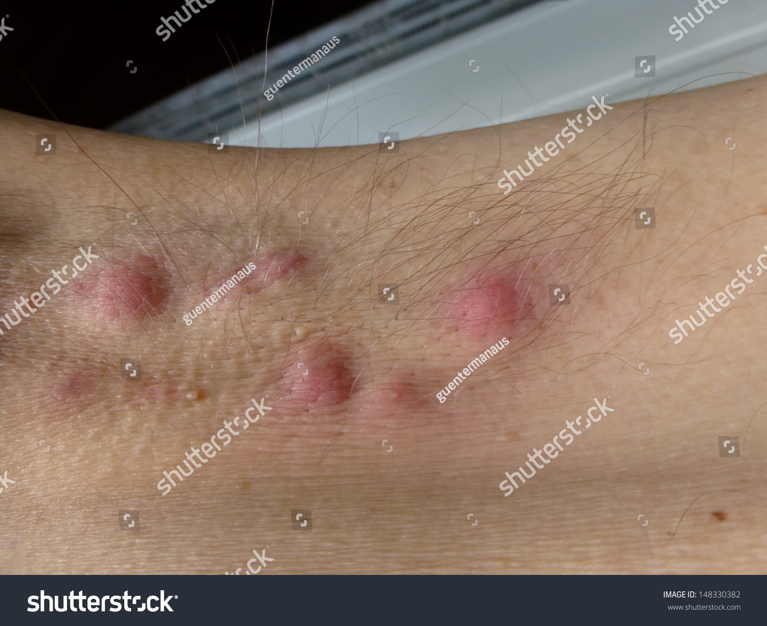 Acne inversa, hidradenitis suppurativa in the armpit, (inflammatory skin disease) #148330382