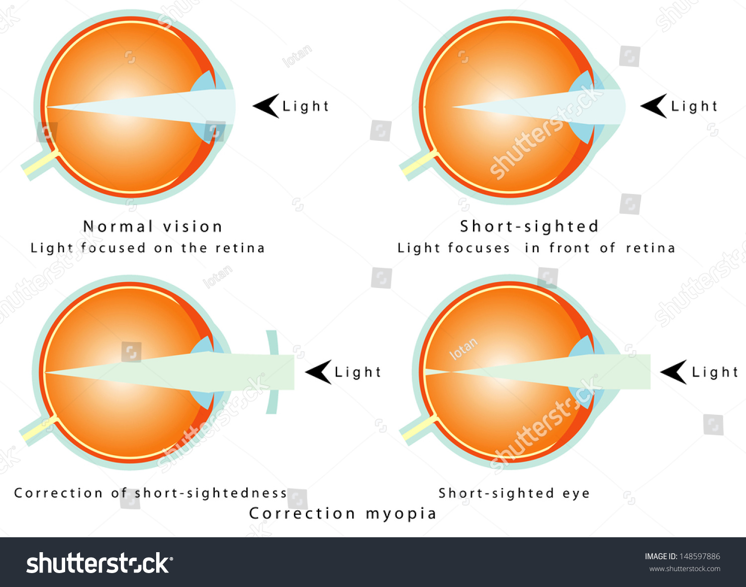 myopia norma
