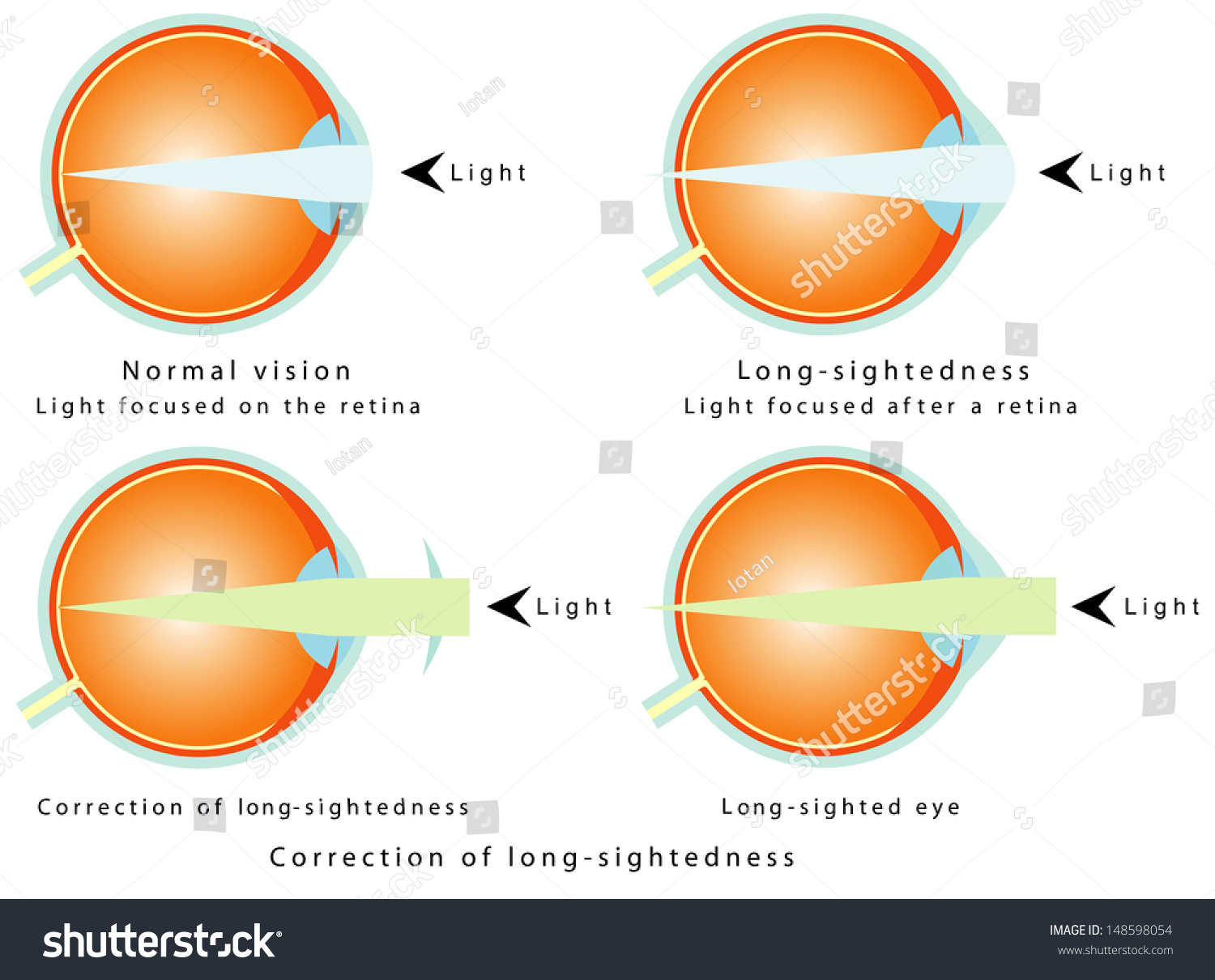 Hyperopia. Normal vision, light focused on the - Royalty Free Stock ...