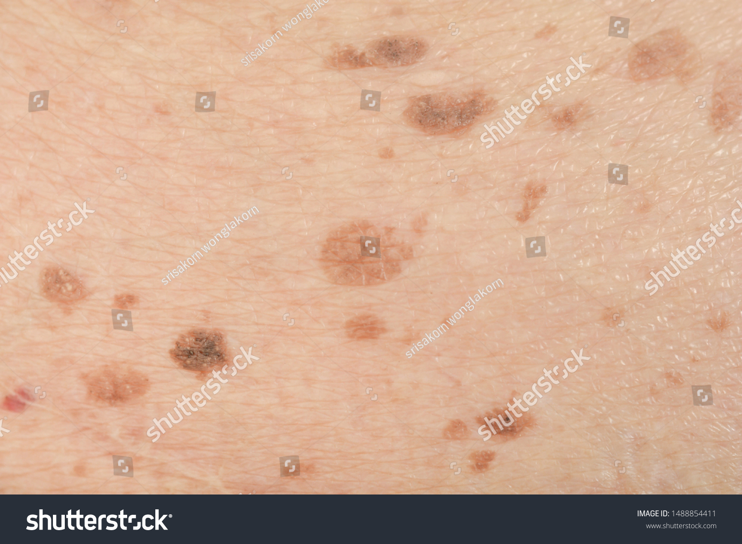 Dark spots and skin problems and itching Skin disease  freckles on the skin #1488854411