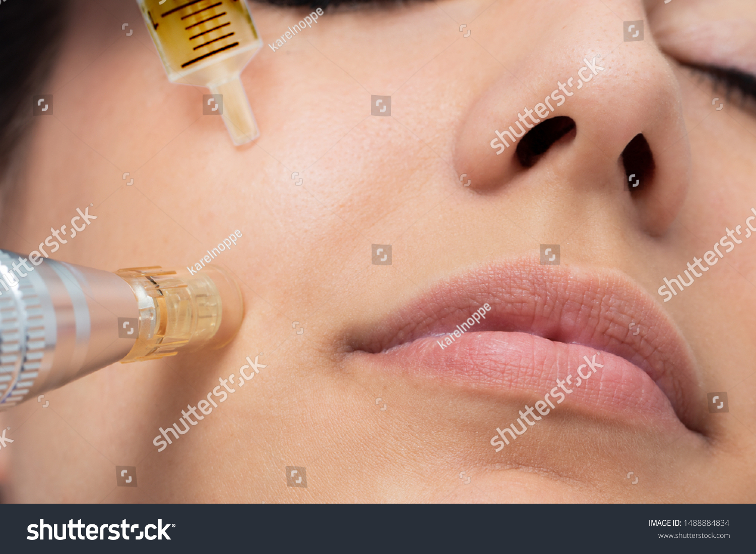 Macro detail of micro needle cosmetic treatment on female cheek. Derma pen and syringe with plant extracts next to face. #1488884834