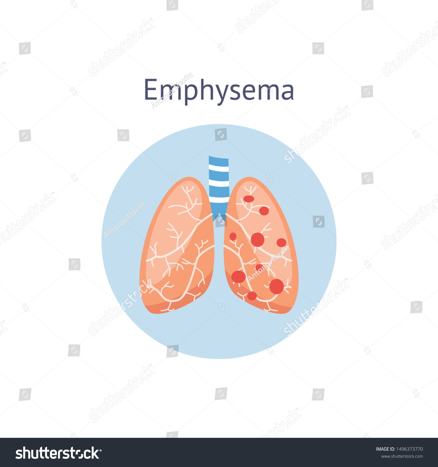 Emphysema chronic obstructive pulmonary disease - Royalty Free Stock ...