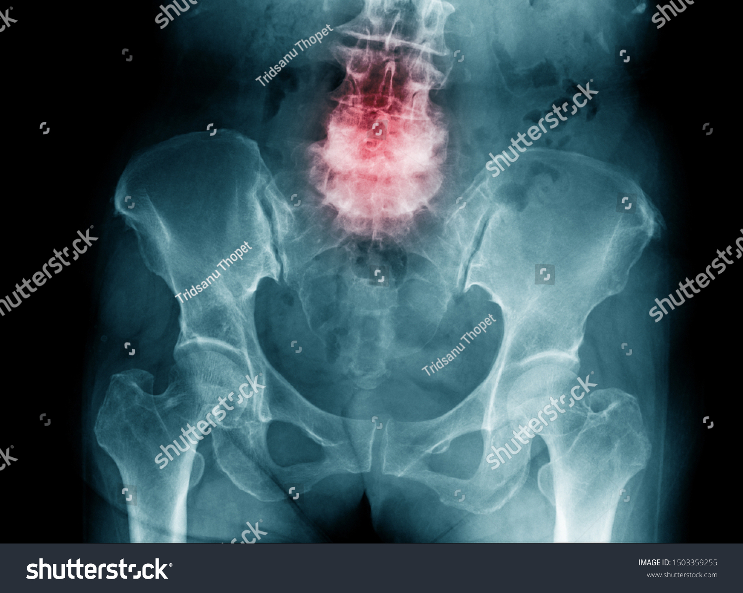 spondylosis x-ray image, x-ray image of compression fracture  L4-5 of human spine #1503359255
