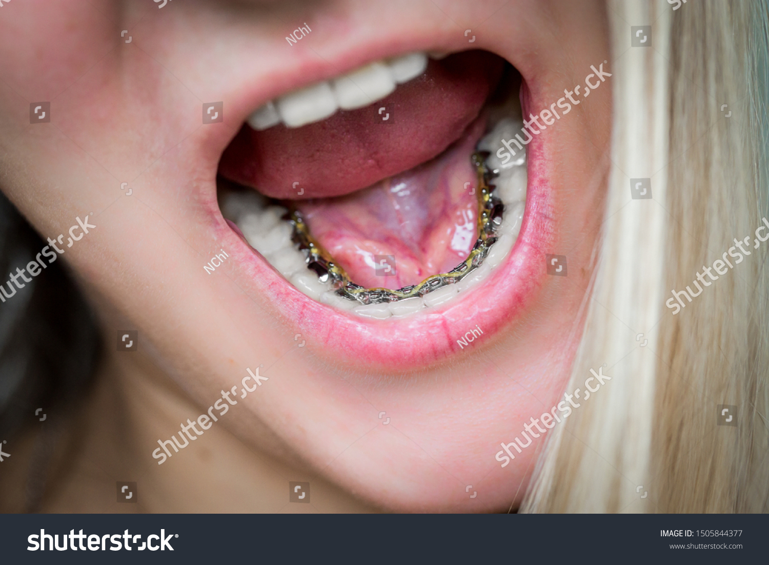 young blonde girl laughs and shows internal lingual invisible braces, mouth close-up, blurred background #1505844377