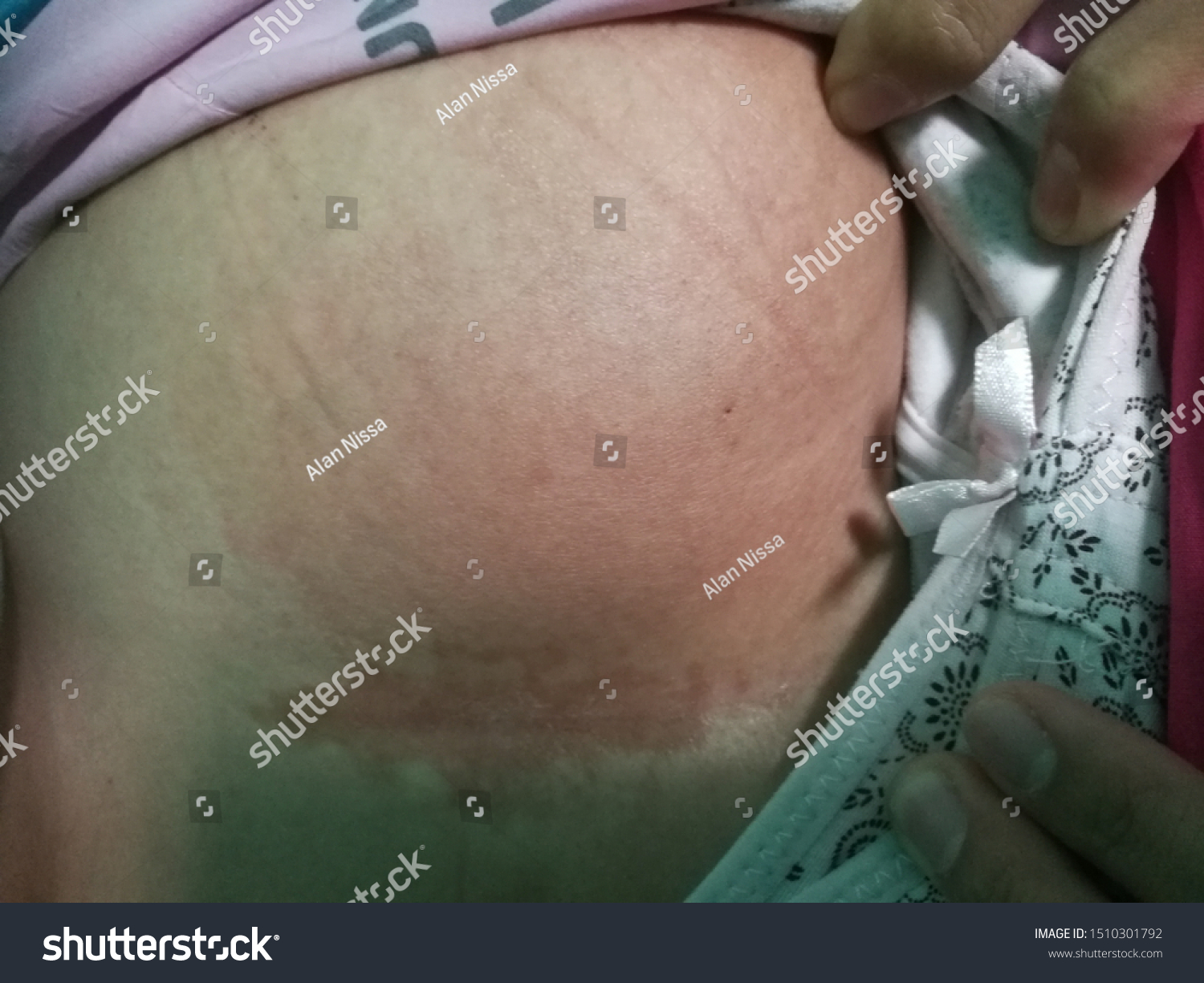 This patient is having anterior abdominal abscess presented with reddish discolouration of skin with lump #1510301792