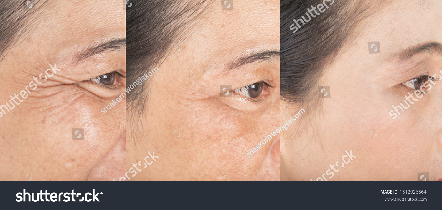 Wrinkles on the eyes.  and before and after melasma  and freckles  facial treatment on face  skin Problem and  make-up in women
 #1512926864