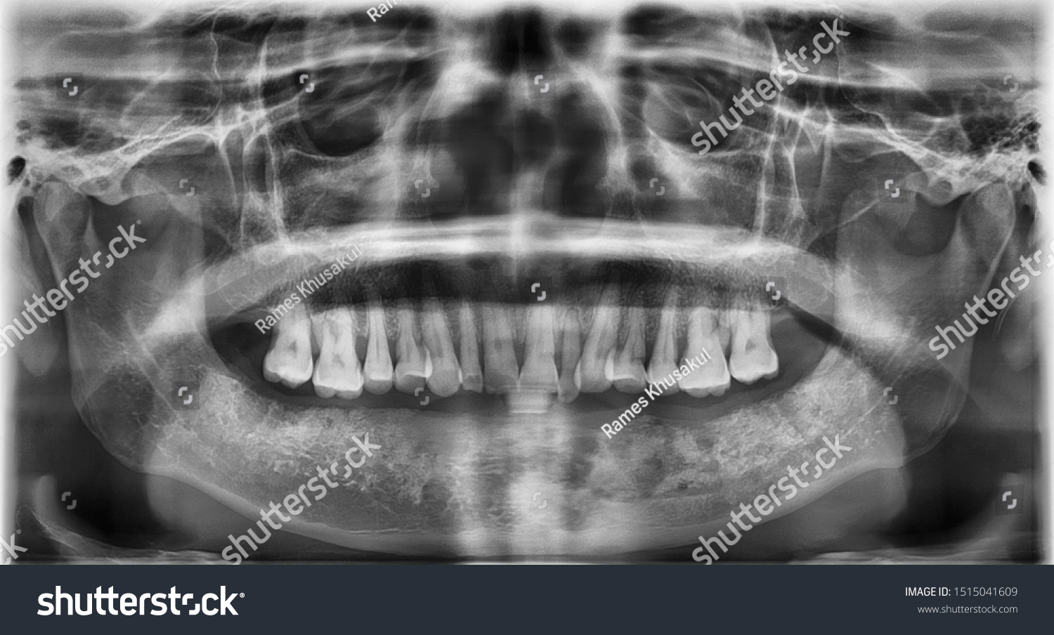 Panoramic film showed osteolytic lesion due to osteoradionecrosis of lower jaw. patient history of tongue resection and radiotherapy.  #1515041609