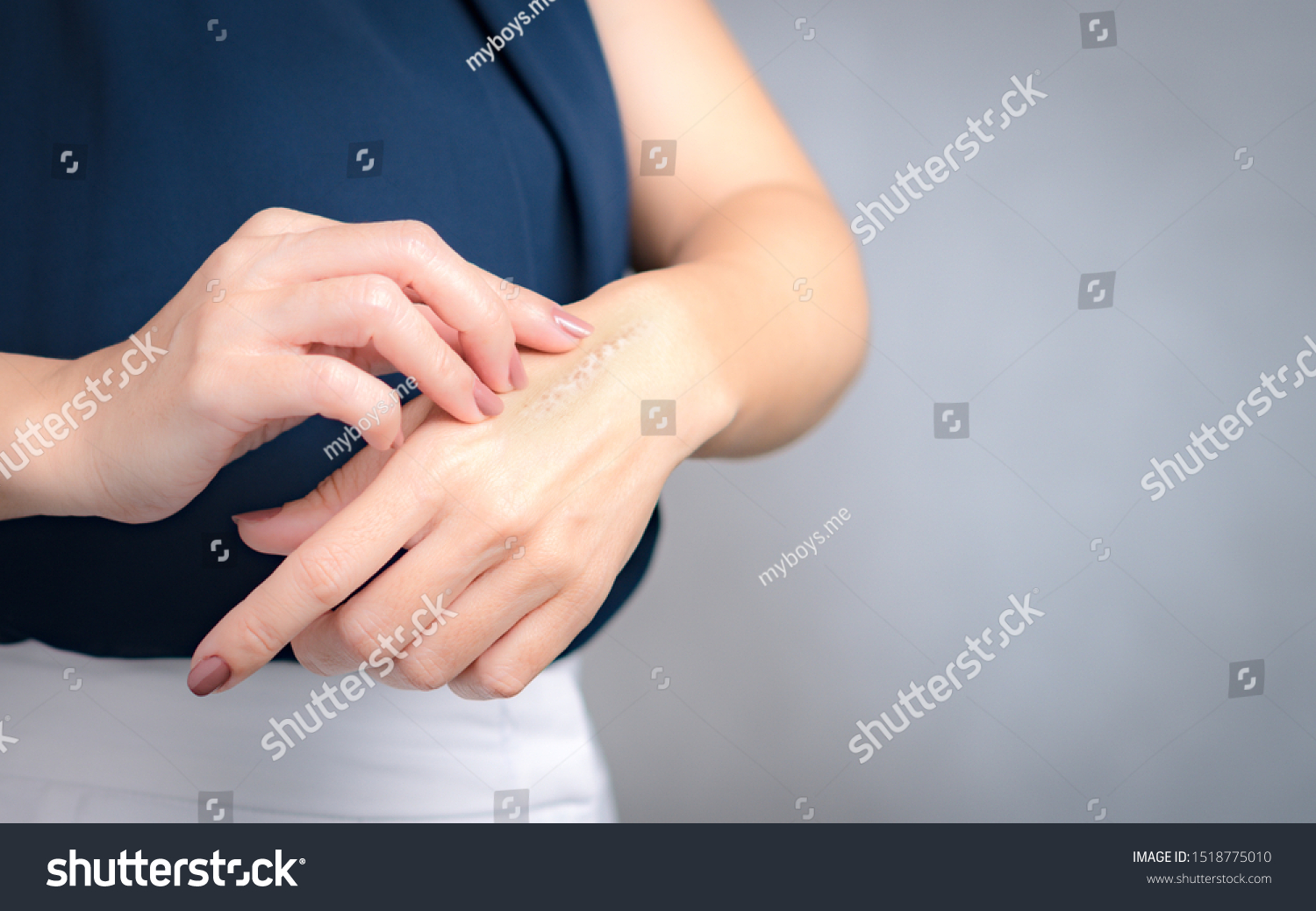 A woman applying scars removal cream to heal the first degree - heat burn wound on her hand. Healing, Removal, treatment, Hot oil burn, Vitamin E, Scars care, Skin care products, Medical cream, Repair #1518775010