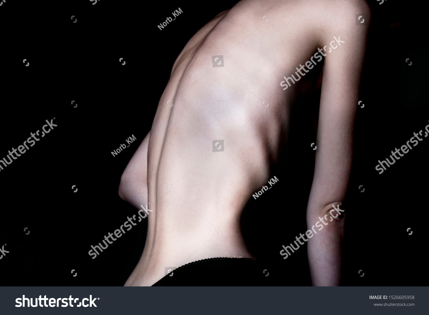 A girl with anorexia turned back, spine and ribs visible. Toned in cold tones for dramatic effect. #1526605958