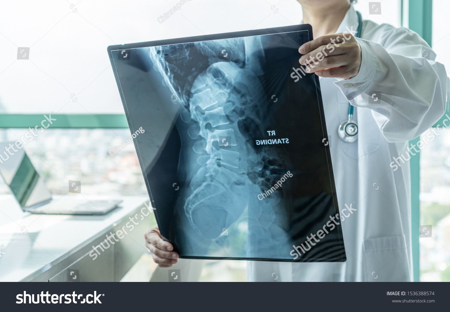 Surgical doctor looking at radiological spinal x-ray film for medical diagnosis on patient’s health on spine disease, bone cancer illness, spinal muscular atrophy, medical healthcare concept #1536388574