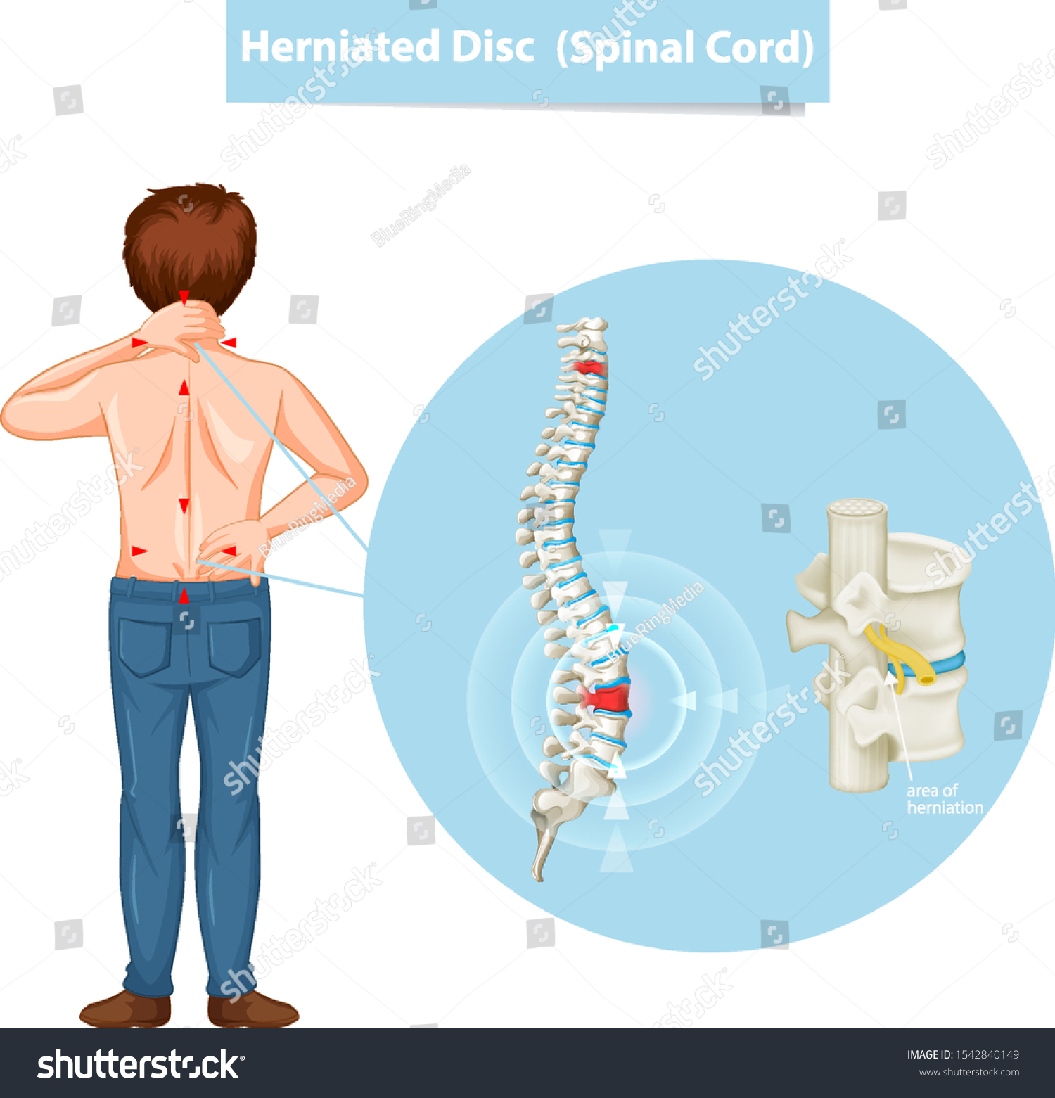 Diagram Showing Herniated Disc Illustration Royalty Free Stock Vector 1542840149