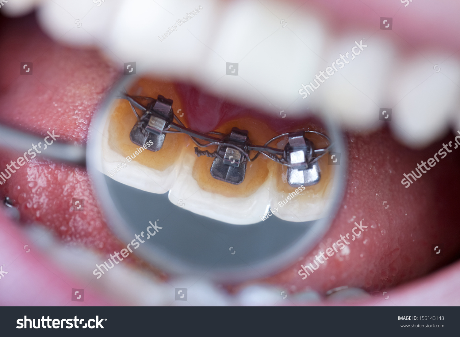 invisible lingual braces on dental mirror #155143148