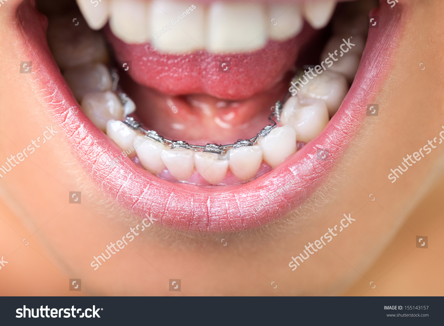 Young woman showing lingual braces, close up  #155143157
