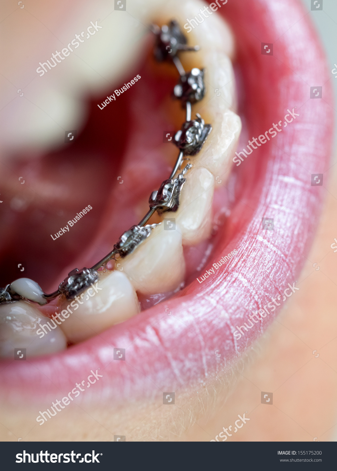 Young woman with lingual braces #155175200