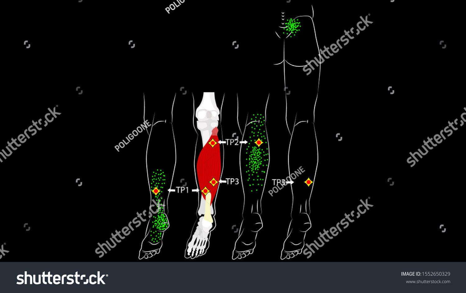 Soleus muscle. Trigger points and reflected leg - Royalty Free Stock ...