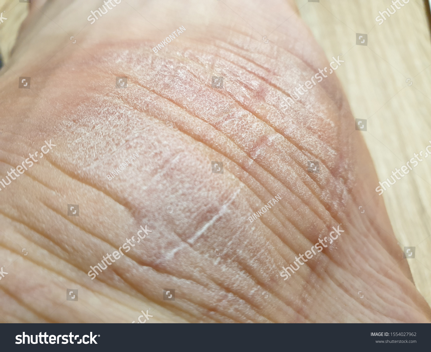 Foot disease. Foot skin disease. Skin disease. #1554027962