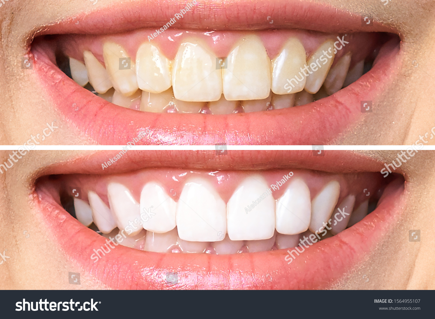 woman teeth before and after whitening. Over white background. Dental clinic patient. Image symbolizes oral care dentistry, stomatology. #1564955107