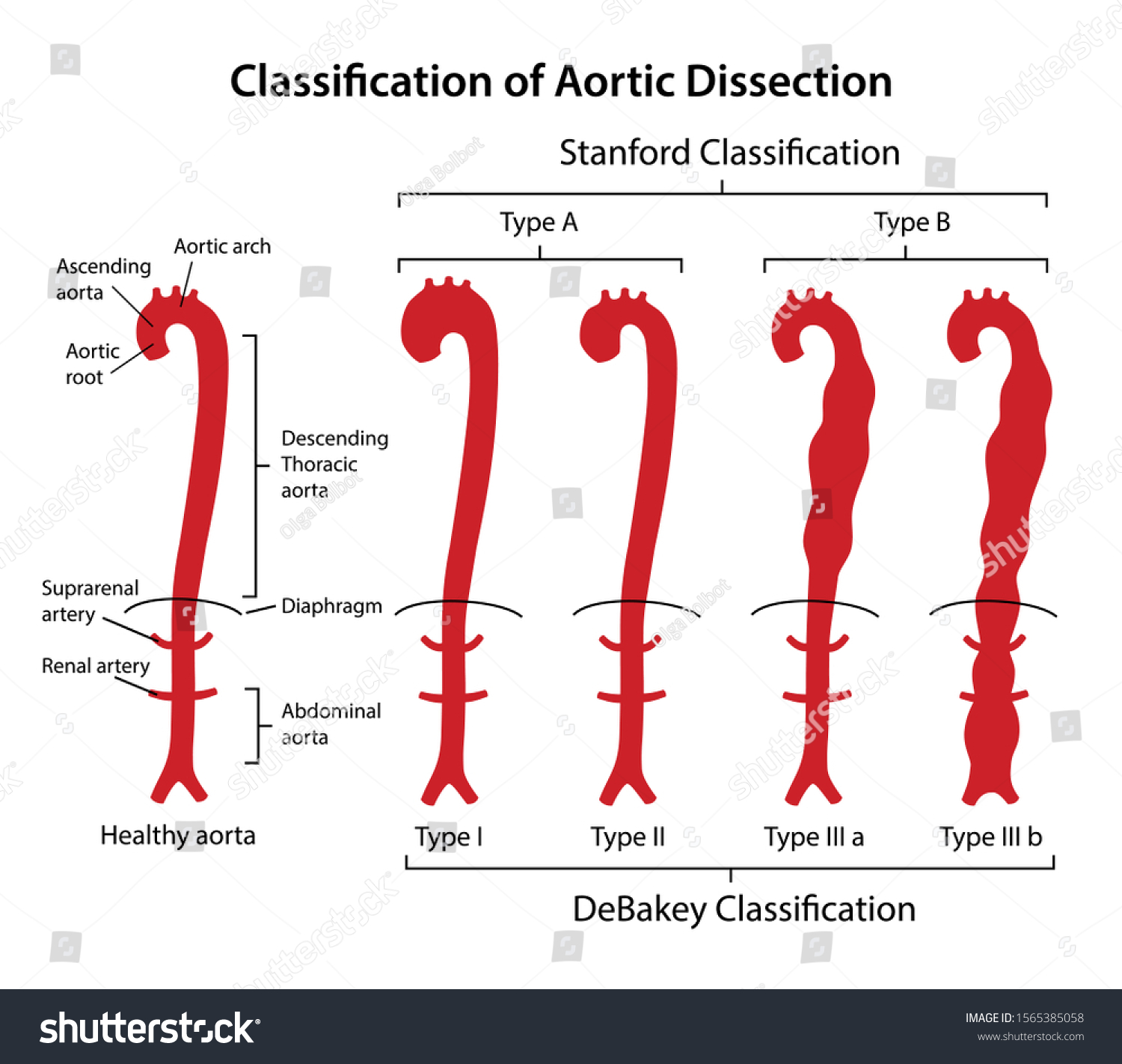 Classification Of Aortic Dissection Stanford Royalty Free Stock Vector 1565385058 3116