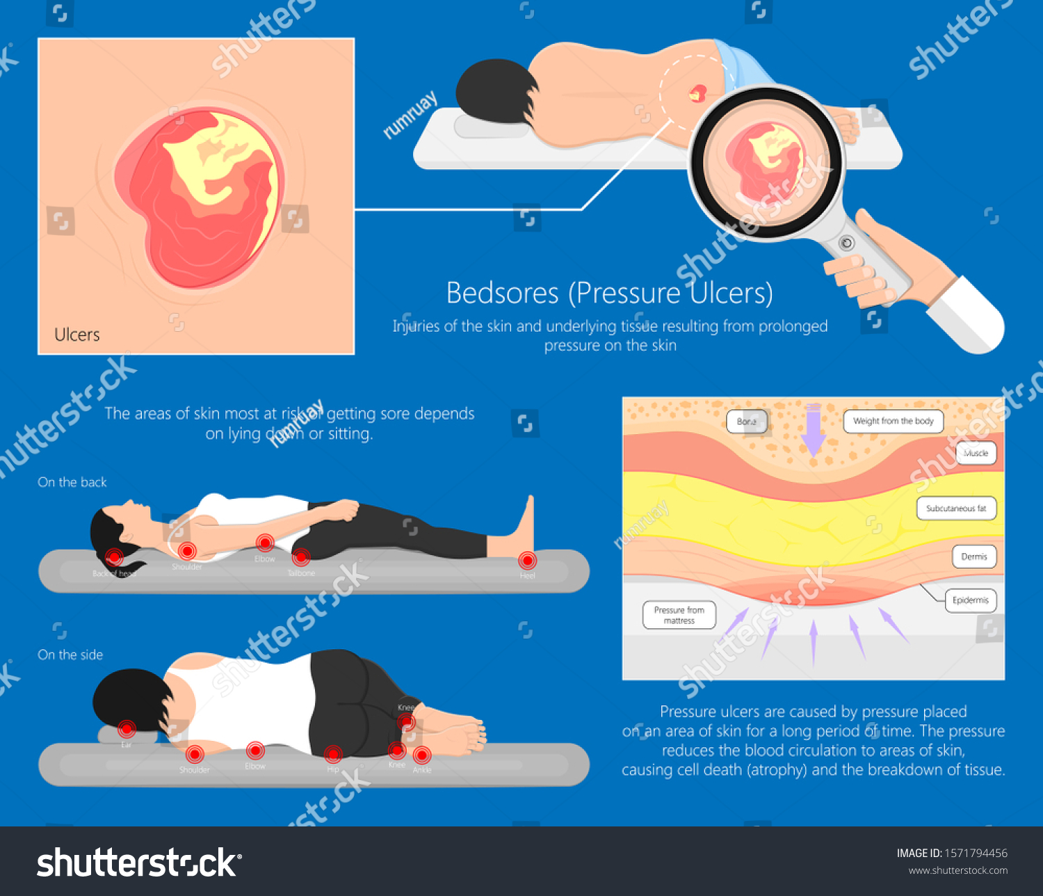 Bedsores (pressure Ulcers) Injuries Skin - Royalty Free Stock Vector ...