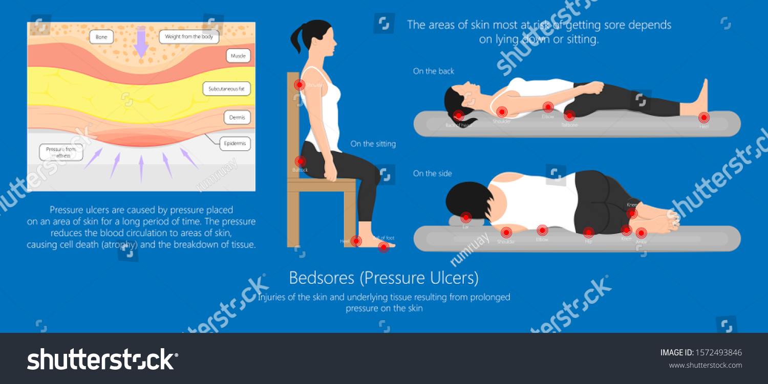 Bedsores (pressure Ulcers) Injuries Skin - Royalty Free Stock Vector ...