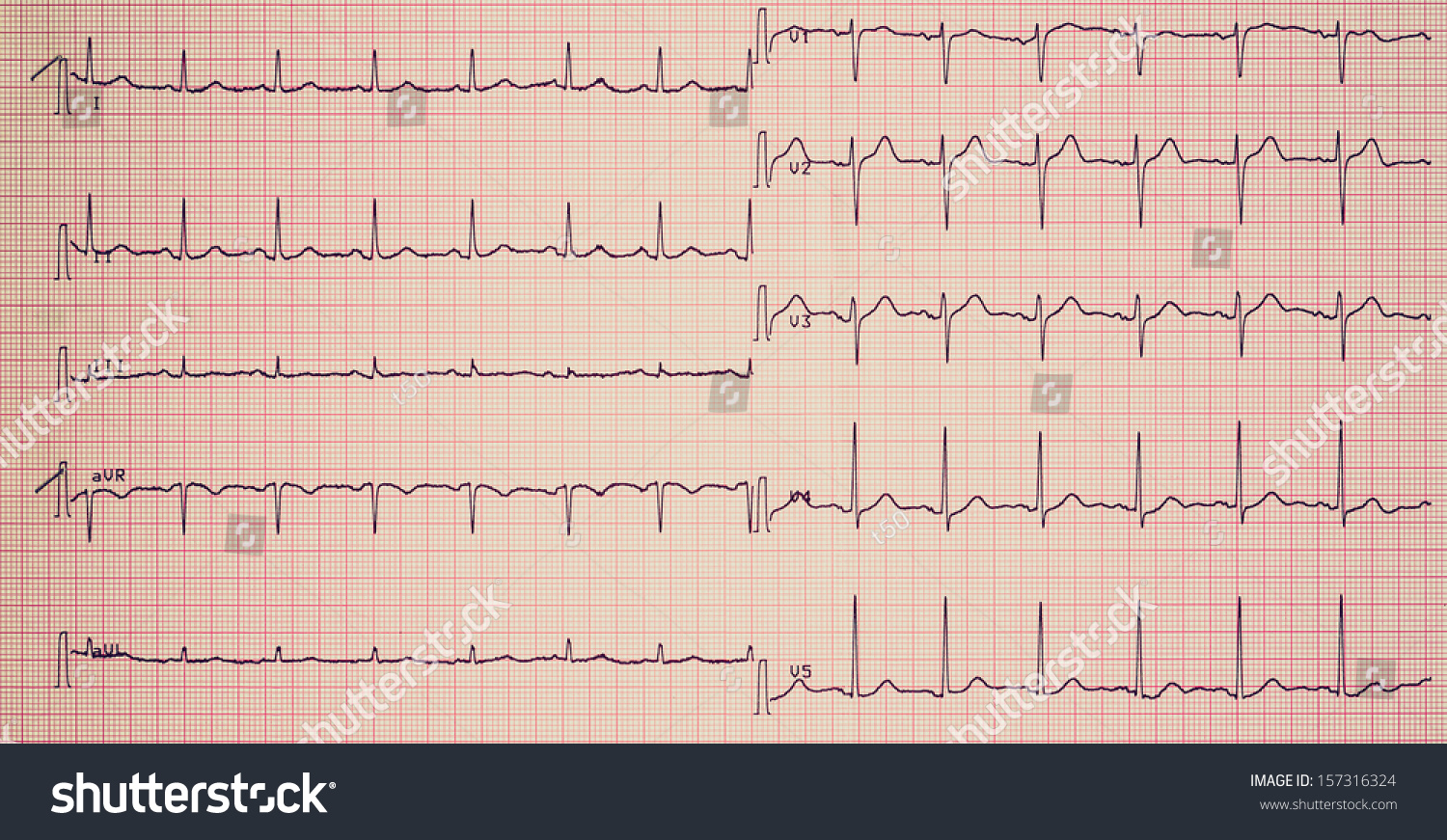 Electrocardiography (aka EKG Elektrokardiogramm) - Royalty Free Stock ...