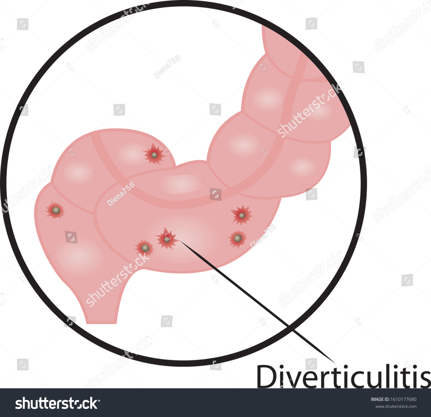 Diverticulitis Intestine Disease Vector Graphic Royalty Free Stock