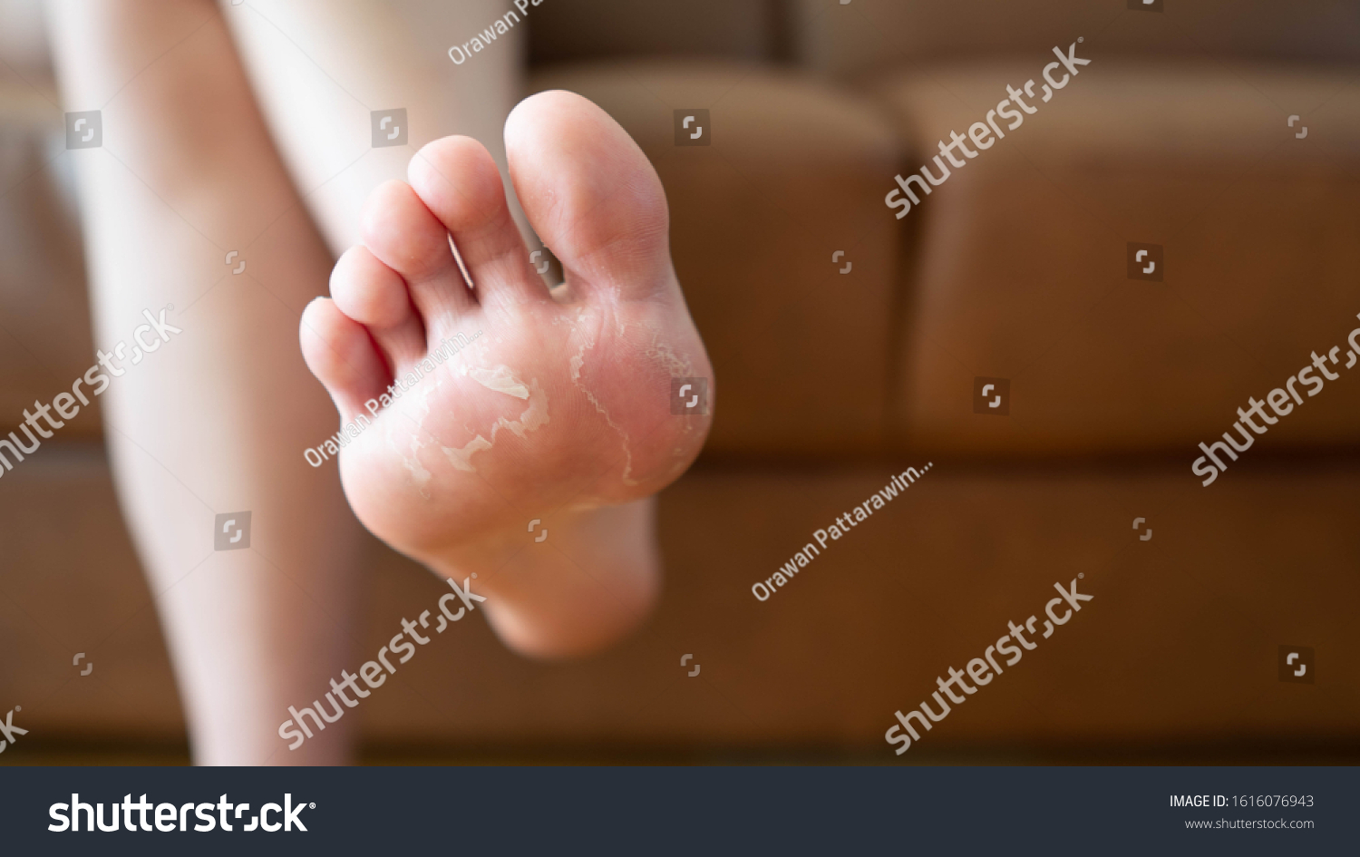 Close up of peeling and cracked foot. Causes of peeling foot included fungal infection (athlete's foot), dermatitis (eczema), sunburn, dry skin, dehydration or sweaty feet. Health care concept. #1616076943