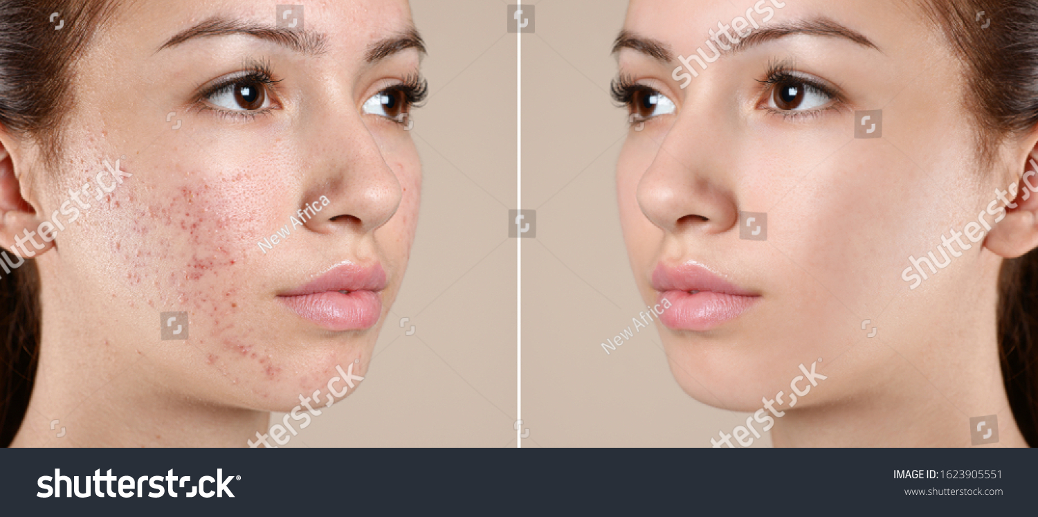 Teenage girl before and after acne treatment on beige background #1623905551