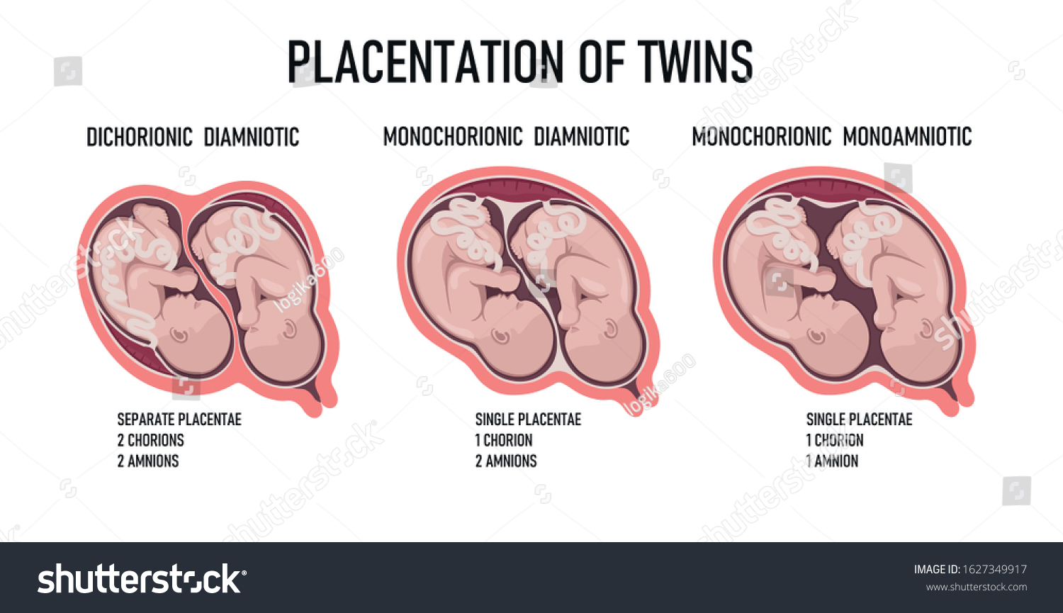 Types Of Twins: Dizygotic, Monozygotic - Royalty Free Stock Vector ...