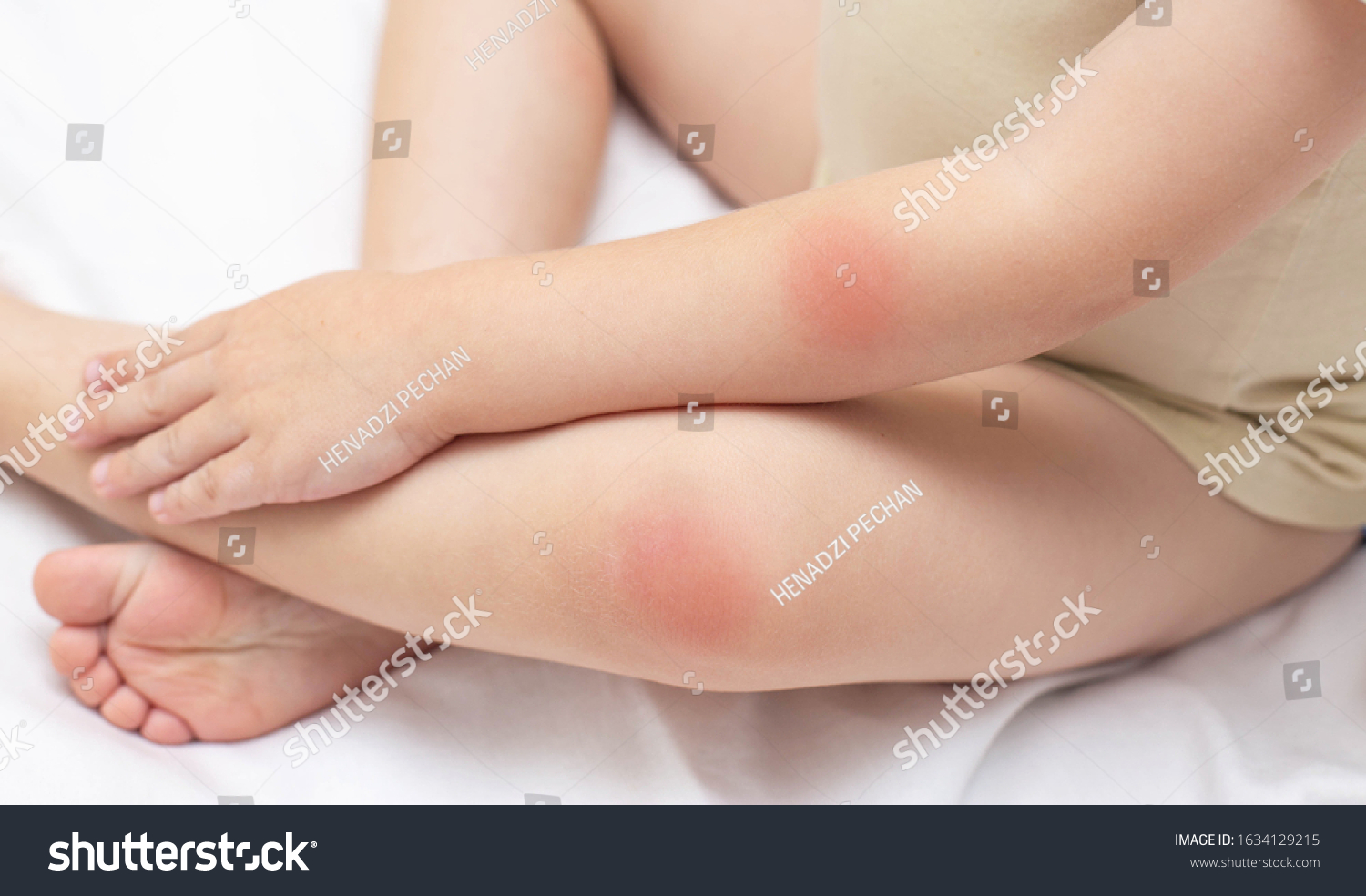 Hands and feet of a young child who has a rash and redness on the skin. The concept of treatment of diseases and skin care in children, background. Dermatology #1634129215