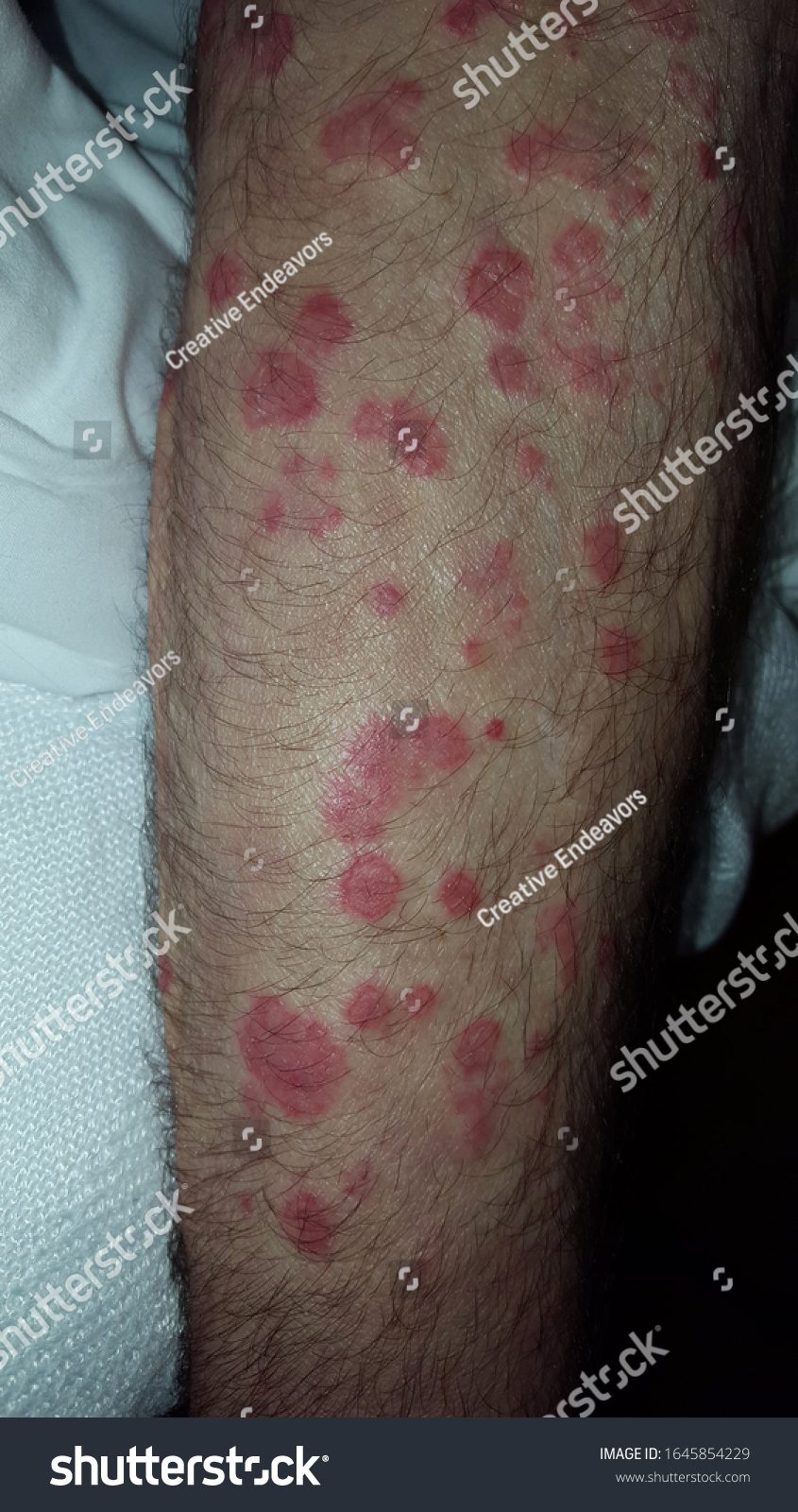 Erythema multiforme annular erythematous - Royalty Free Stock Photo ...