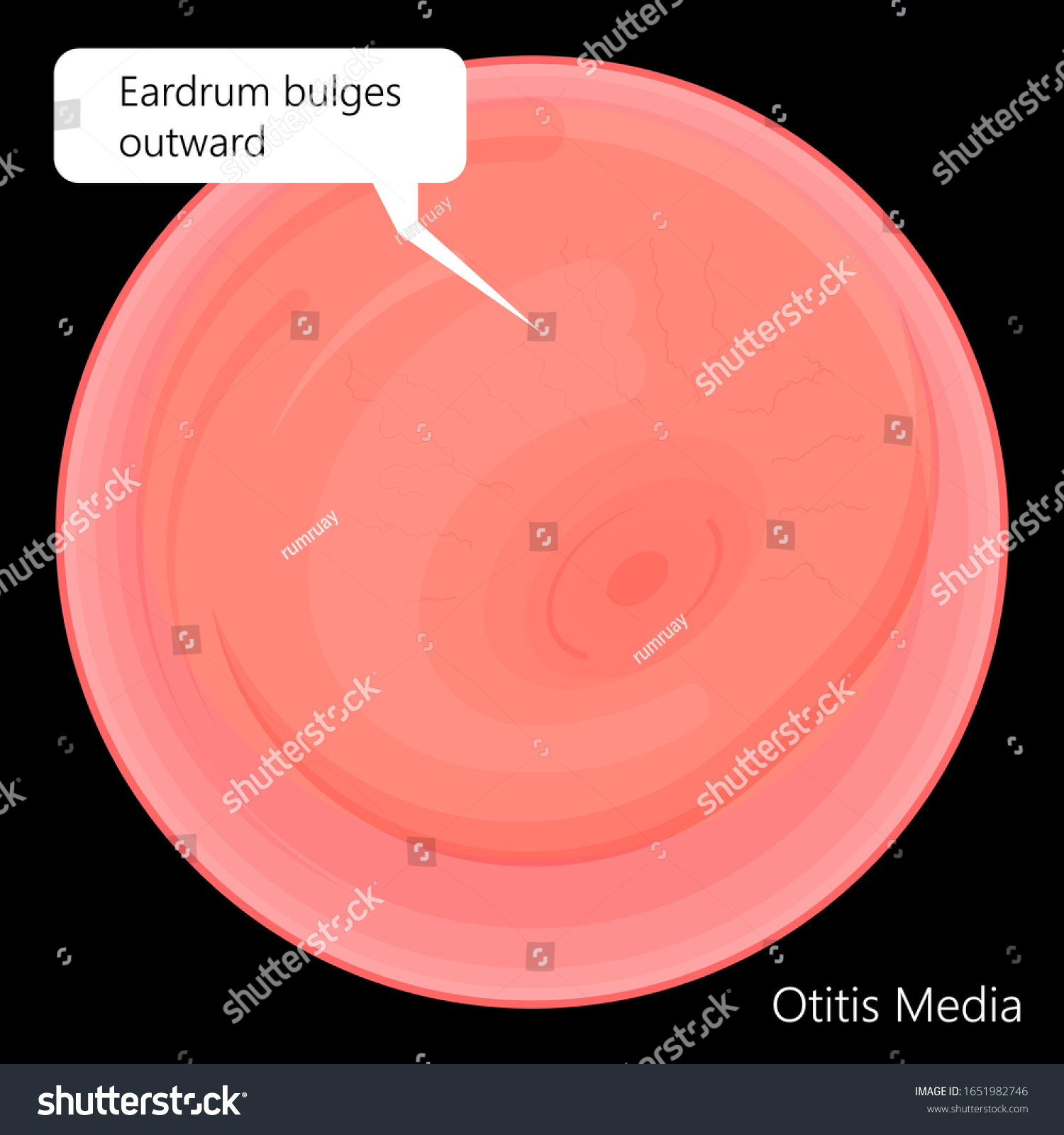 Acute Otitis Media Air Filled Space Eardrum Royalty Free Stock Vector 1651982746 