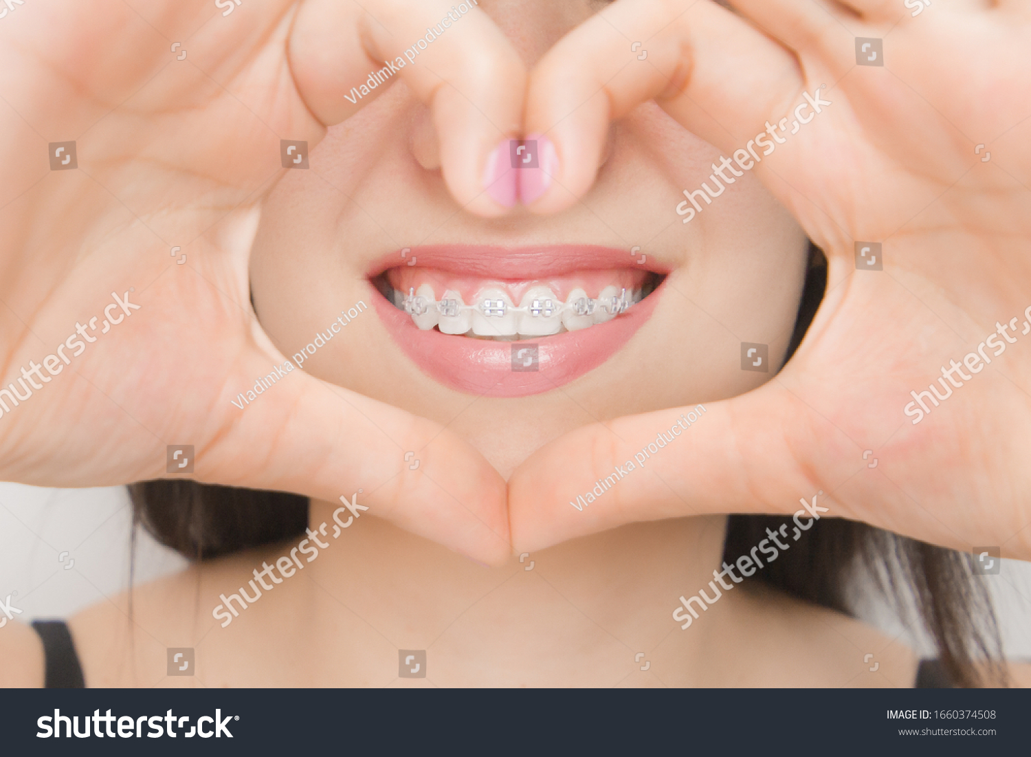 Dental braces in happy womans mouths through the heart. Brackets on the teeth after whitening. Self-ligating brackets with metal ties and gray elastics or rubber bands for perfect smile. Orthodontic #1660374508