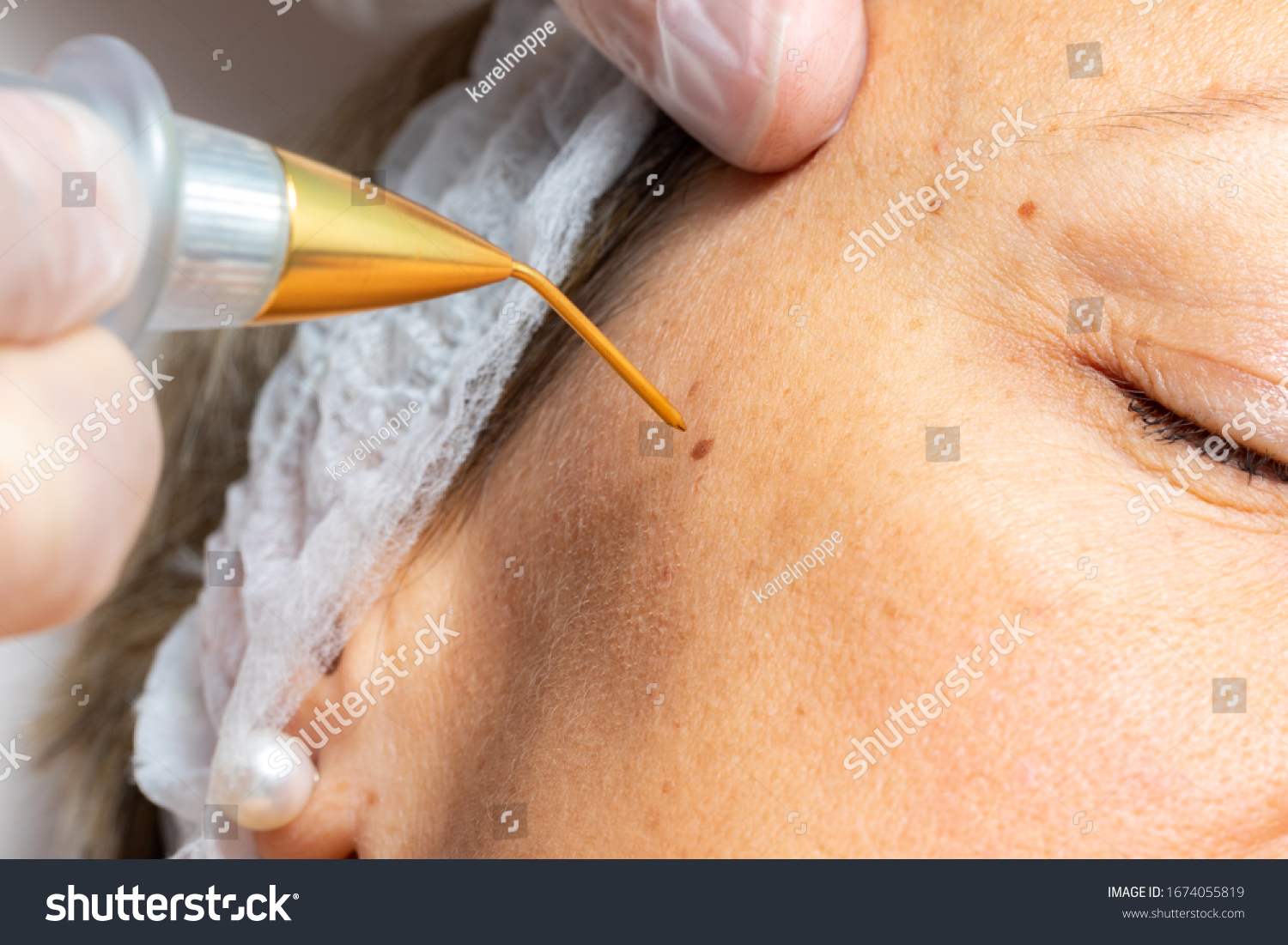 Macro close up detail of laser plasma pen removing facial wart on middle aged woman. #1674055819