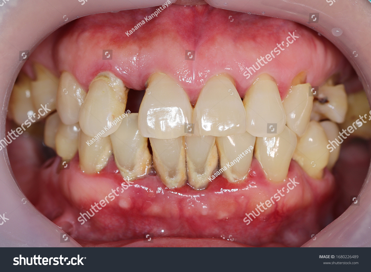 Periodontitis is often known as 'Gum Disease' and is a very common condition in which the gums and deeper periodontal structures become inflamed. #1680226489