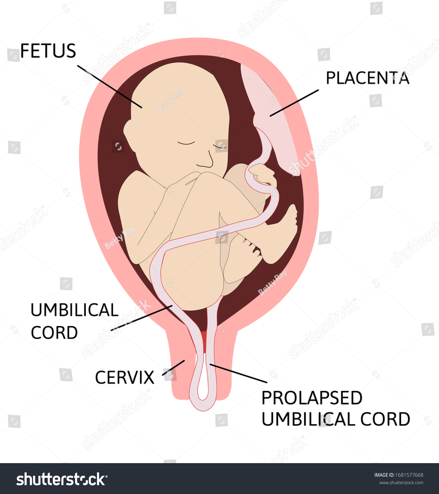 Prolapsed umbilical cord. umbilical cord comes - Royalty Free Stock ...