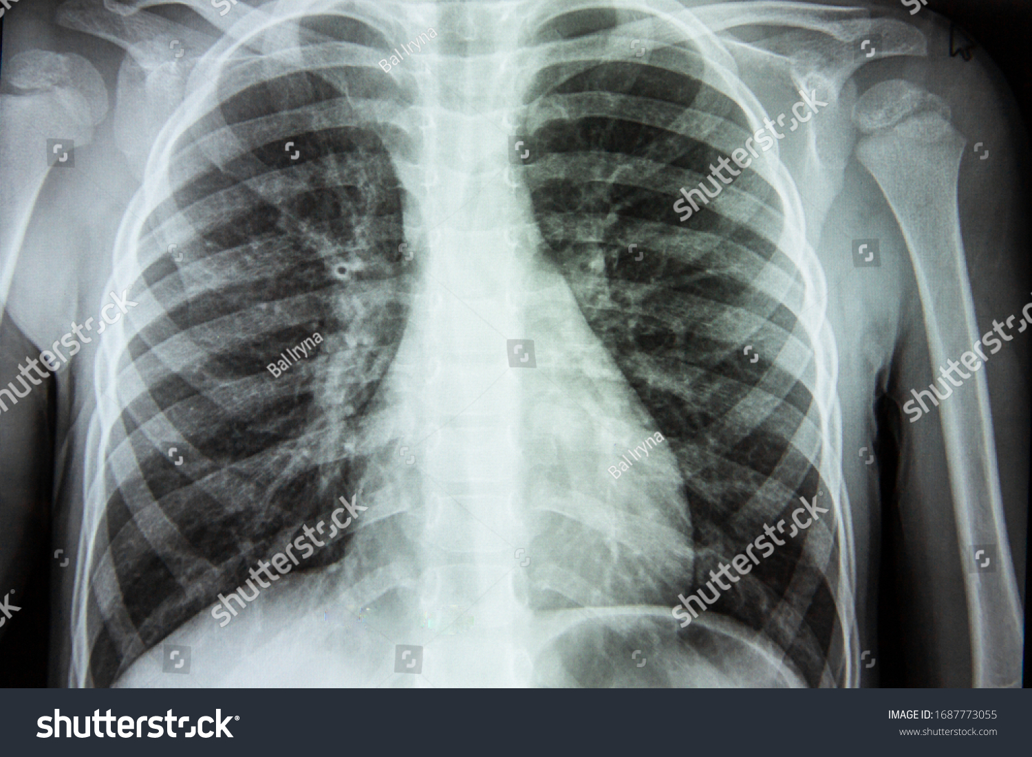 X-ray of a person s lungs with a disease. Coronavirus or cancer infected lungs. Virus screening #1687773055
